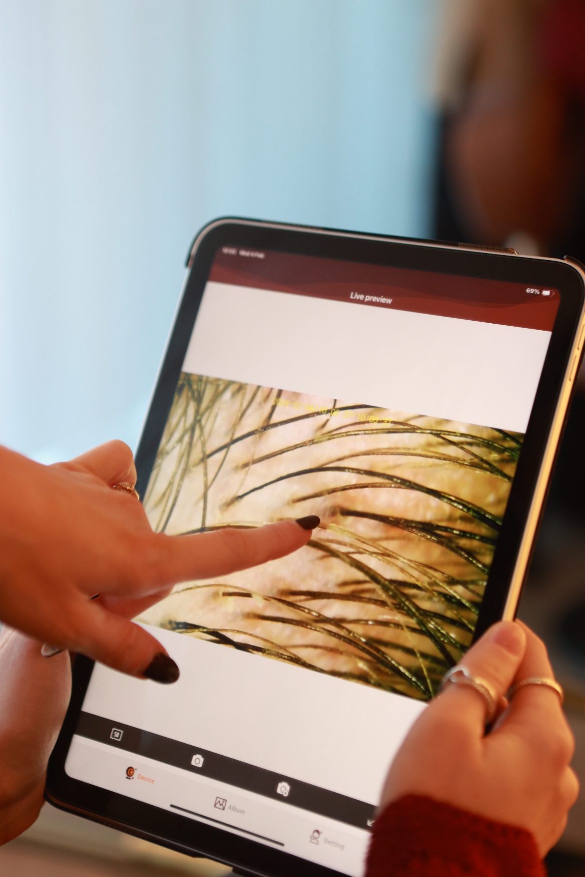 Scalp analysis live preview on tablet